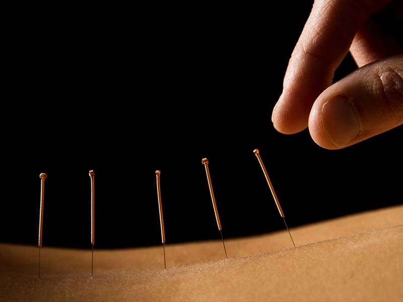 針灸 Acupuncture